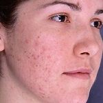 Herbal Remedies for Acne Scars | Health, BeAuTy & Fitness